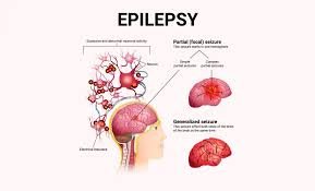 Epilepsy Surgery